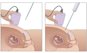 dna test during pregnancy