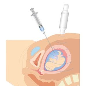invasive dna test while pregnant